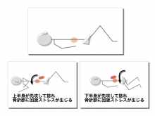 骨折 禁忌 圧迫